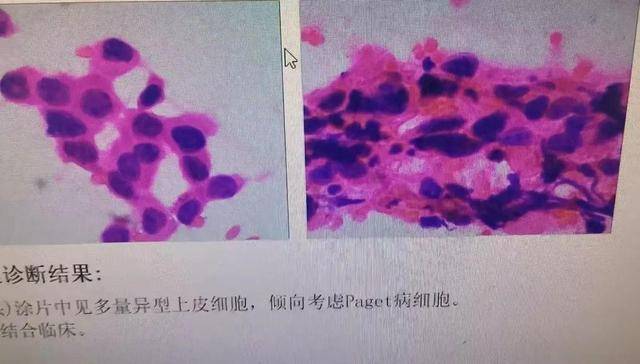 皇冠信用盘怎么弄
_以为是湿疹皇冠信用盘怎么弄
，结果竟是癌！宁波女子悔惨：反复涂了一年药膏都没好！很多患者首诊都去了皮肤科